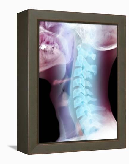 Normal Neck, X-ray-Du Cane Medical-Framed Premier Image Canvas