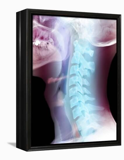 Normal Neck, X-ray-Du Cane Medical-Framed Premier Image Canvas