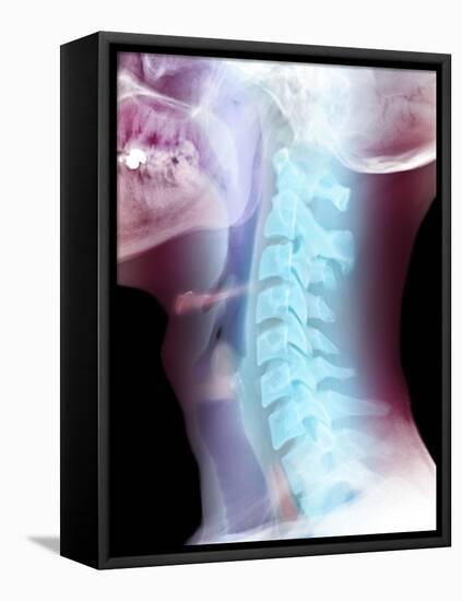 Normal Neck, X-ray-Du Cane Medical-Framed Premier Image Canvas