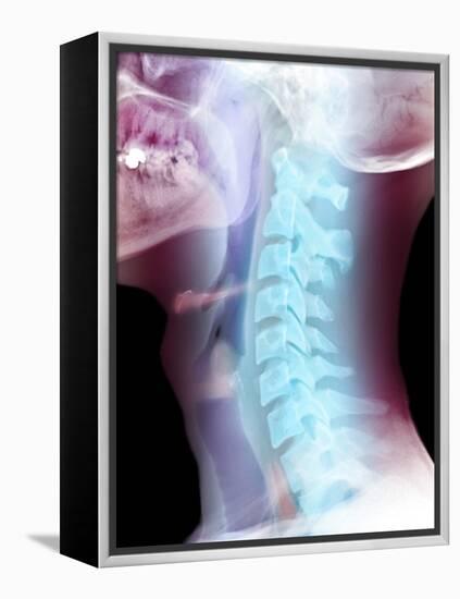 Normal Neck, X-ray-Du Cane Medical-Framed Premier Image Canvas