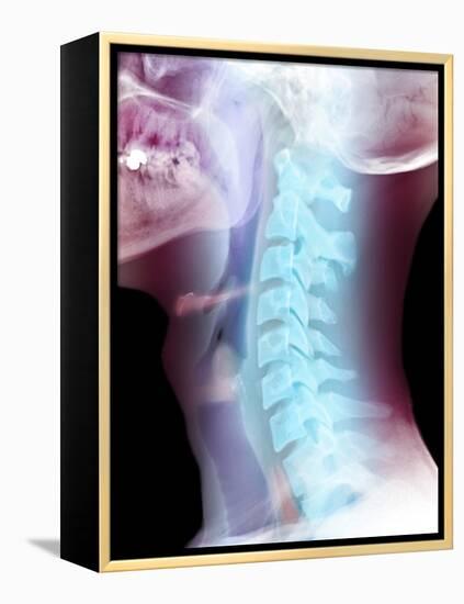 Normal Neck, X-ray-Du Cane Medical-Framed Premier Image Canvas