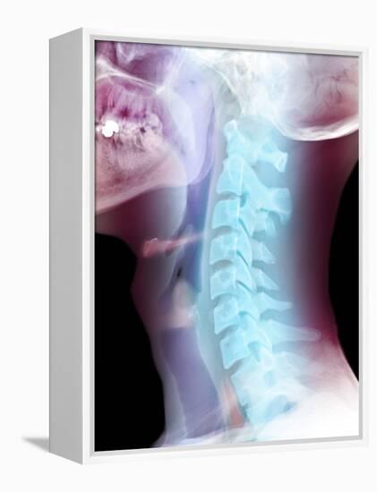 Normal Neck, X-ray-Du Cane Medical-Framed Premier Image Canvas