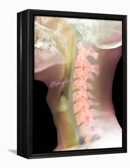 Normal Neck, X-ray-Du Cane Medical-Framed Premier Image Canvas