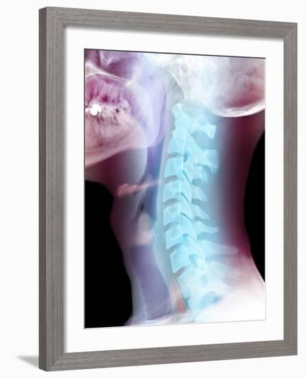 Normal Neck, X-ray-Du Cane Medical-Framed Photographic Print