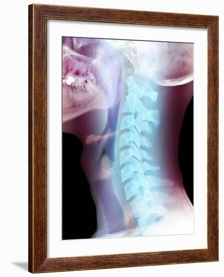 Normal Neck, X-ray-Du Cane Medical-Framed Photographic Print