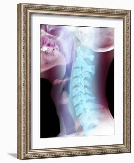 Normal Neck, X-ray-Du Cane Medical-Framed Photographic Print