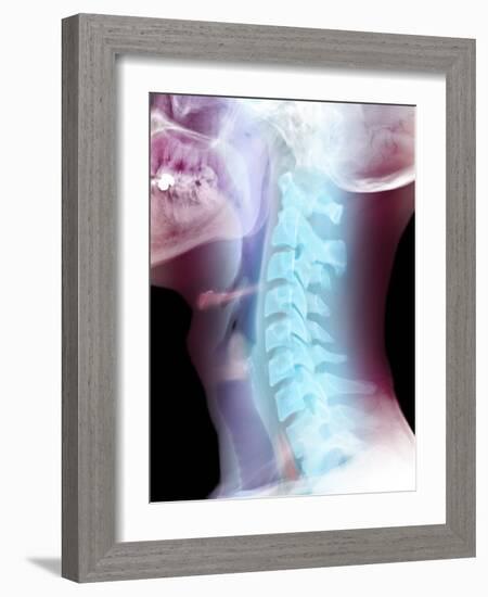 Normal Neck, X-ray-Du Cane Medical-Framed Photographic Print