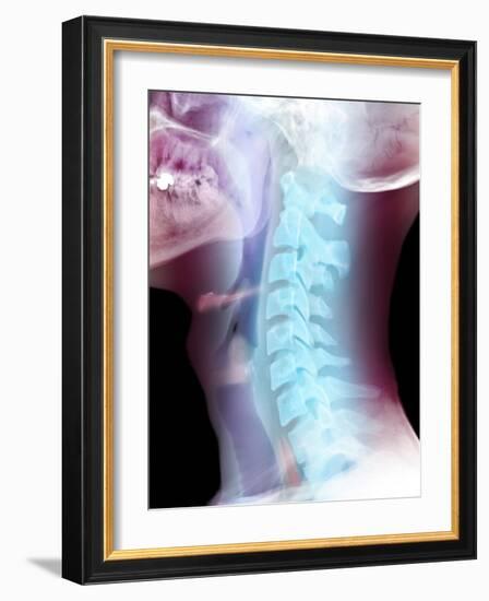 Normal Neck, X-ray-Du Cane Medical-Framed Photographic Print