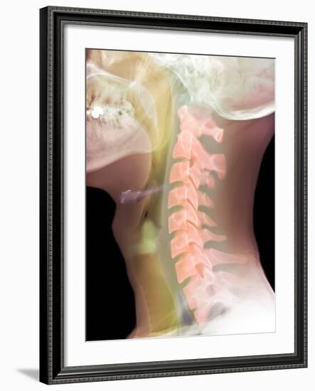 Normal Neck, X-ray-Du Cane Medical-Framed Photographic Print