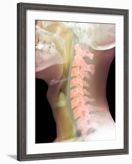 Normal Neck, X-ray-Du Cane Medical-Framed Photographic Print