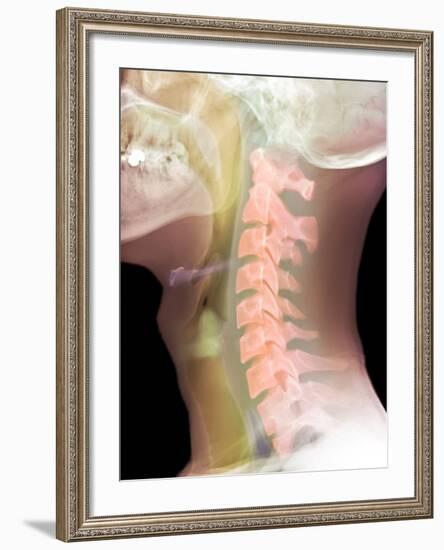 Normal Neck, X-ray-Du Cane Medical-Framed Photographic Print