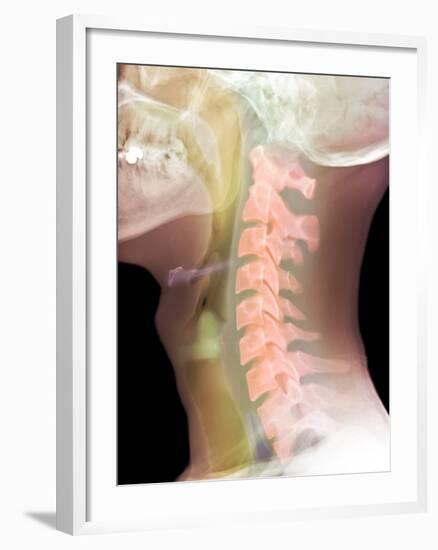 Normal Neck, X-ray-Du Cane Medical-Framed Photographic Print