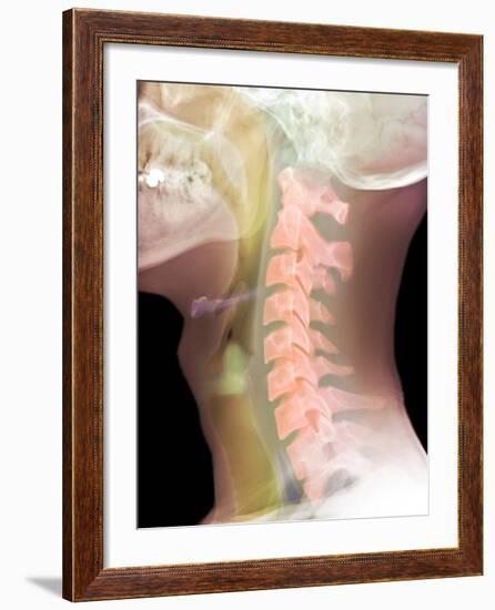 Normal Neck, X-ray-Du Cane Medical-Framed Photographic Print