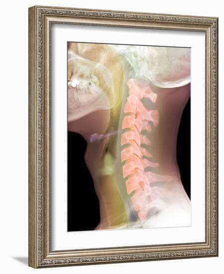 Normal Neck, X-ray-Du Cane Medical-Framed Photographic Print