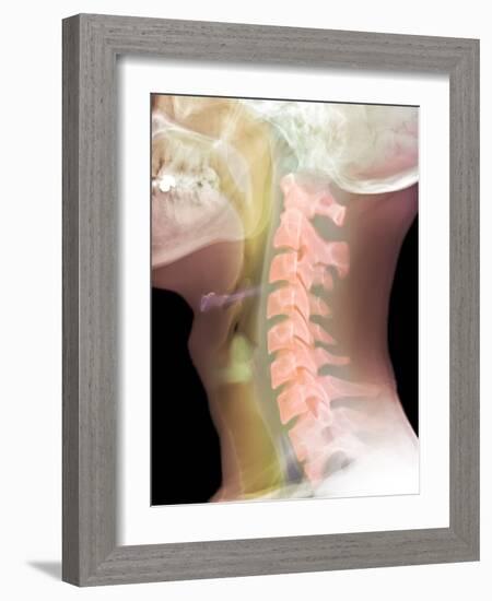 Normal Neck, X-ray-Du Cane Medical-Framed Photographic Print