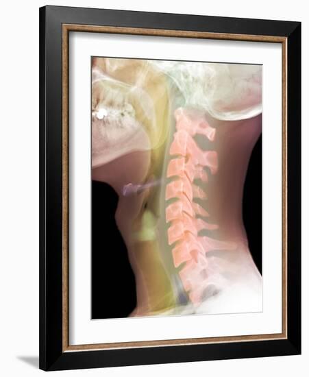 Normal Neck, X-ray-Du Cane Medical-Framed Photographic Print