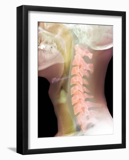 Normal Neck, X-ray-Du Cane Medical-Framed Photographic Print