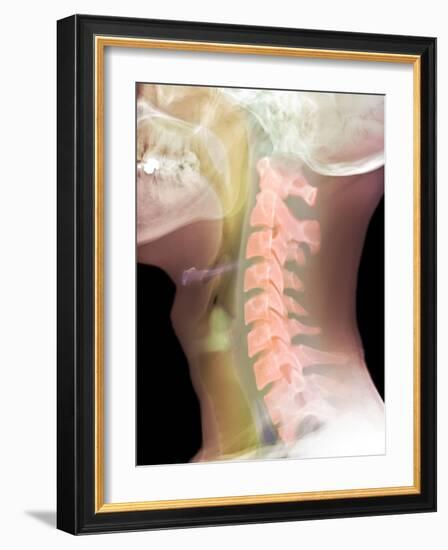 Normal Neck, X-ray-Du Cane Medical-Framed Photographic Print