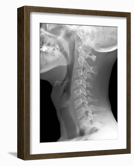 Normal Neck, X-ray-Du Cane Medical-Framed Photographic Print