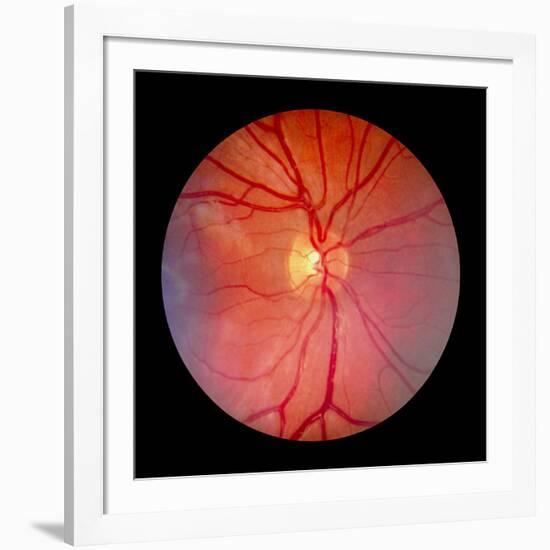 Normal Retina of Eye-Rory McClenaghan-Framed Photographic Print