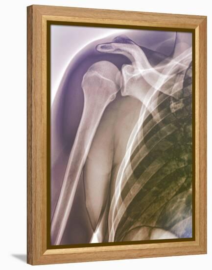 Normal Shoulder, X-ray-ZEPHYR-Framed Premier Image Canvas