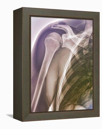 Normal Shoulder, X-ray-ZEPHYR-Framed Premier Image Canvas