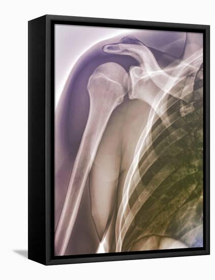 Normal Shoulder, X-ray-ZEPHYR-Framed Premier Image Canvas