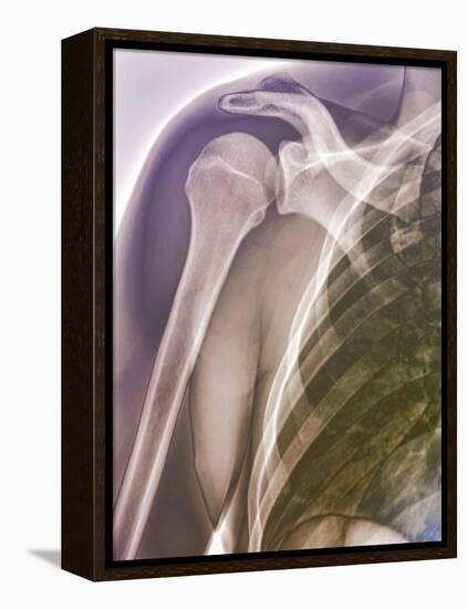 Normal Shoulder, X-ray-ZEPHYR-Framed Premier Image Canvas