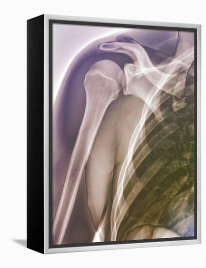 Normal Shoulder, X-ray-ZEPHYR-Framed Premier Image Canvas