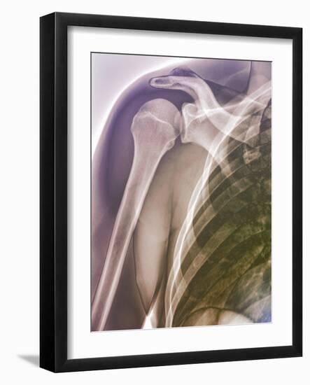 Normal Shoulder, X-ray-ZEPHYR-Framed Photographic Print