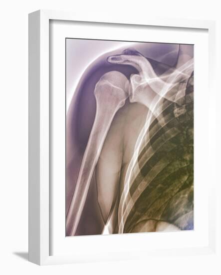 Normal Shoulder, X-ray-ZEPHYR-Framed Photographic Print