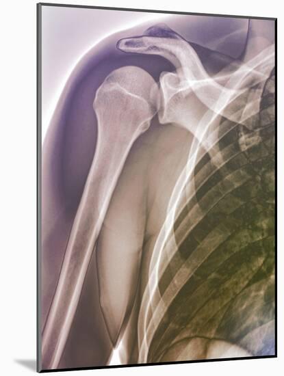 Normal Shoulder, X-ray-ZEPHYR-Mounted Photographic Print