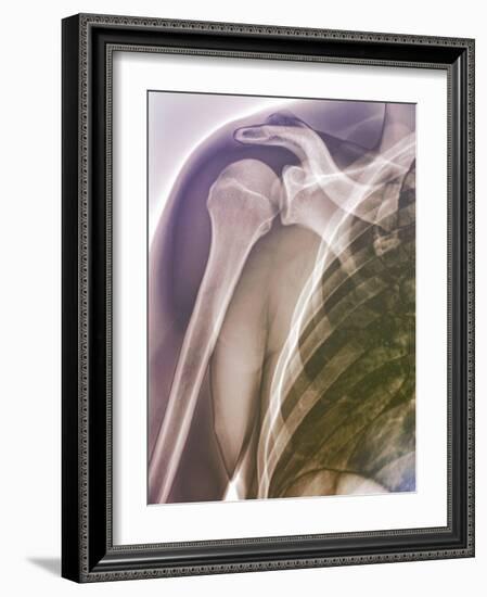 Normal Shoulder, X-ray-ZEPHYR-Framed Photographic Print