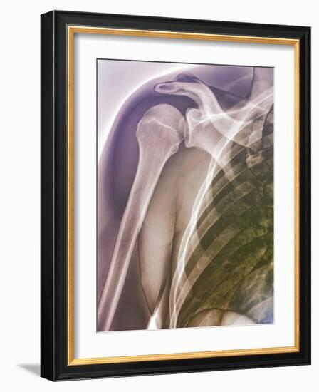 Normal Shoulder, X-ray-ZEPHYR-Framed Photographic Print