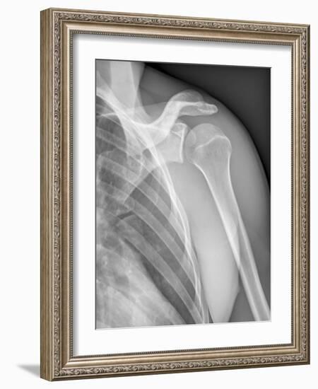 Normal Shoulder, X-ray-ZEPHYR-Framed Photographic Print