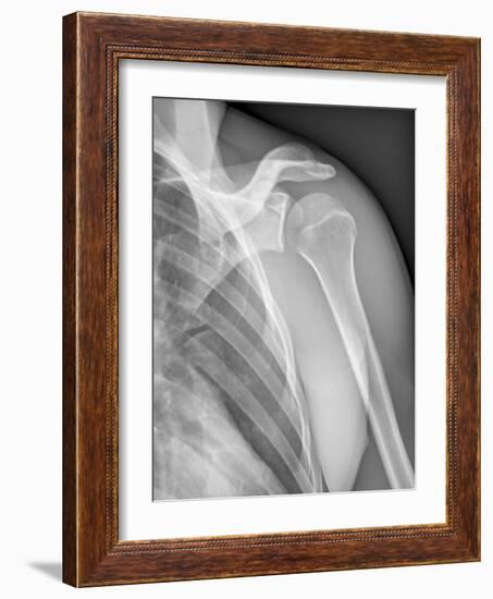 Normal Shoulder, X-ray-ZEPHYR-Framed Photographic Print