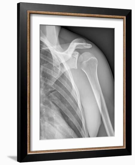 Normal Shoulder, X-ray-ZEPHYR-Framed Photographic Print