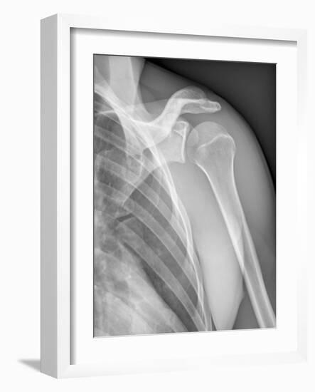 Normal Shoulder, X-ray-ZEPHYR-Framed Photographic Print