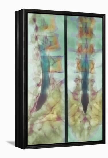 Normal Spinal Cord, X-ray-Science Photo Library-Framed Premier Image Canvas