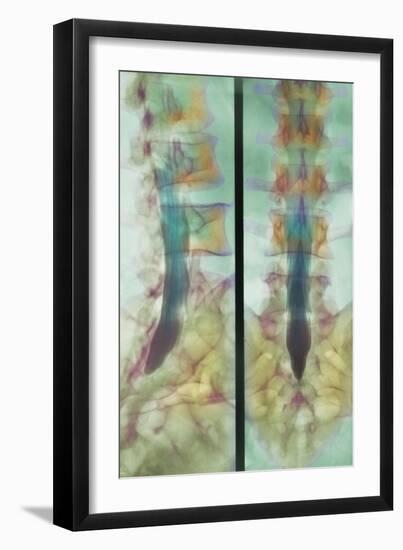 Normal Spinal Cord, X-ray-Science Photo Library-Framed Photographic Print