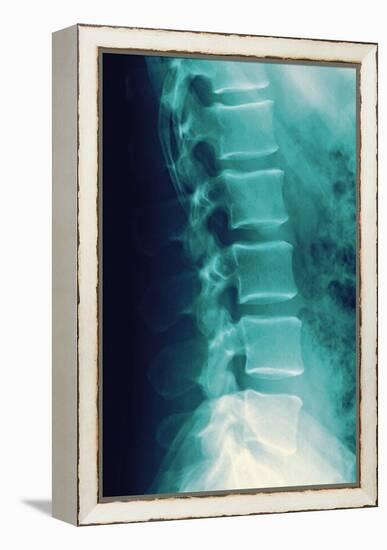 Normal Spine, X-ray-Miriam Maslo-Framed Premier Image Canvas