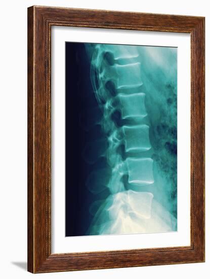 Normal Spine, X-ray-Miriam Maslo-Framed Photographic Print