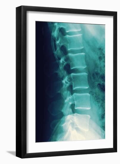 Normal Spine, X-ray-Miriam Maslo-Framed Photographic Print