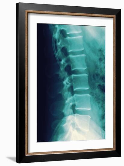 Normal Spine, X-ray-Miriam Maslo-Framed Photographic Print