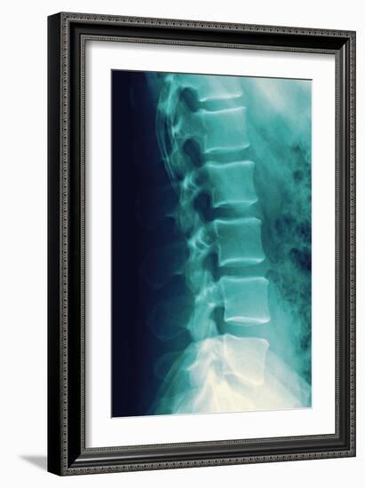 Normal Spine, X-ray-Miriam Maslo-Framed Photographic Print