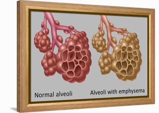 Normal vs. Emphysematous Alveoli-Gwen Shockey-Framed Premier Image Canvas