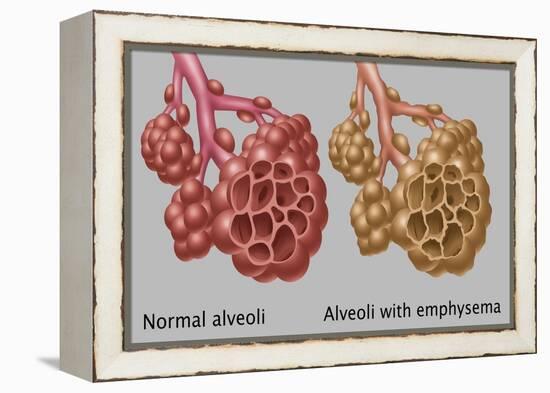 Normal vs. Emphysematous Alveoli-Gwen Shockey-Framed Premier Image Canvas