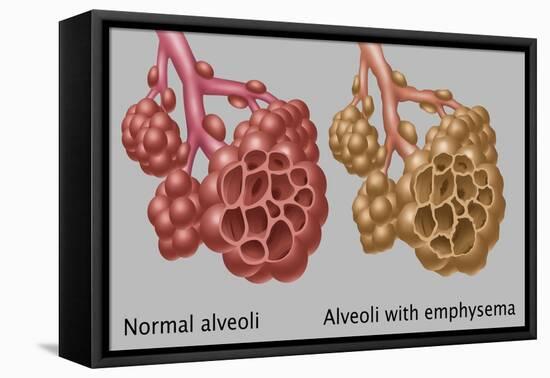 Normal vs. Emphysematous Alveoli-Gwen Shockey-Framed Premier Image Canvas