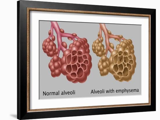 Normal vs. Emphysematous Alveoli-Gwen Shockey-Framed Giclee Print