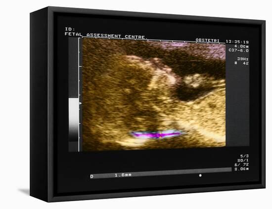 Nuchal Scan for Down's Syndrome-Science Photo Library-Framed Premier Image Canvas